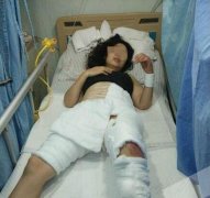 为了捡鸡蛋，永川一女子整条左腿被烧焦