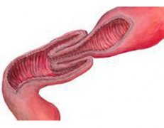 孩子一阵一阵喊肚子痛 小心可能是肠套叠