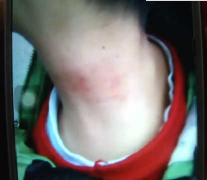 重庆一幼儿园老师 掐伤孩子后玩失踪