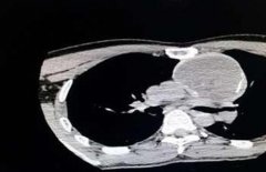 男子莫名肩痛 一查竟是畸胎瘤在作怪