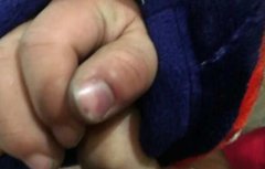 三岁幼童拇指意外被夹伤  母亲怒找肇事者求“道歉”