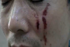 男子遭遇野蛮女友欲分手 结果脸被抓烂了