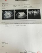 女子怀过一次选择流产 6年再也没怀上过